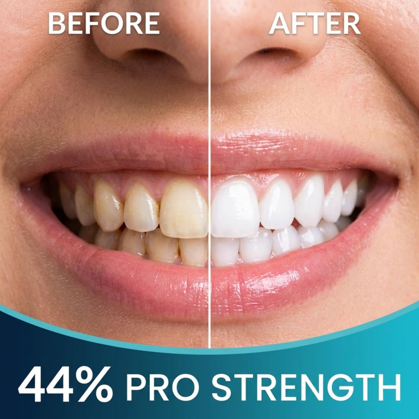 Teeth Whitening Pen